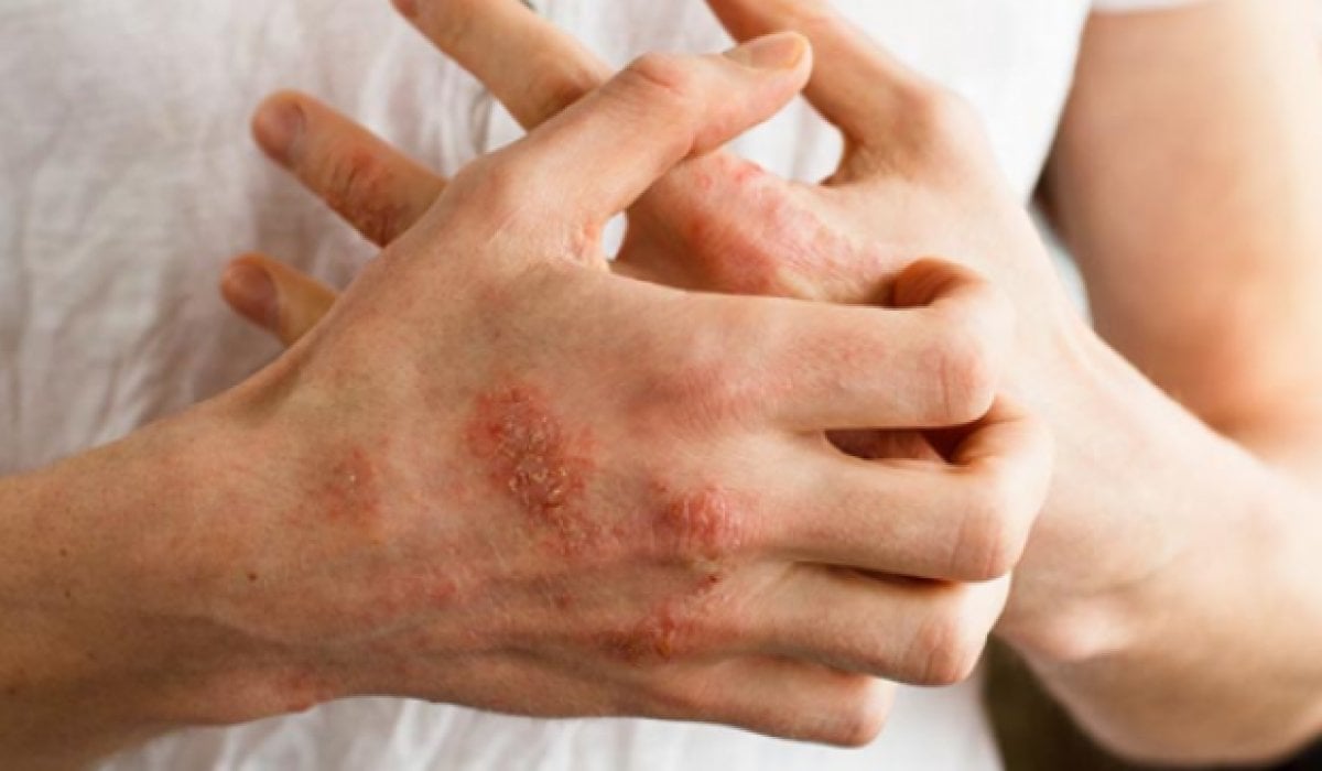 Koronavirüs aşısı sonrası dikkat edilmesi gereken alerji belirtileri #1