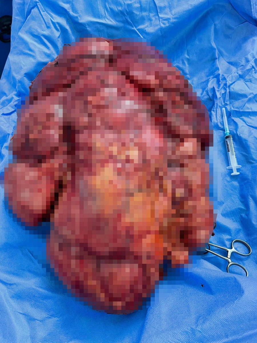 Aydın’da safra kesesi taşı dendi, karnından 15 kilo tümör çıkarıldı  #2