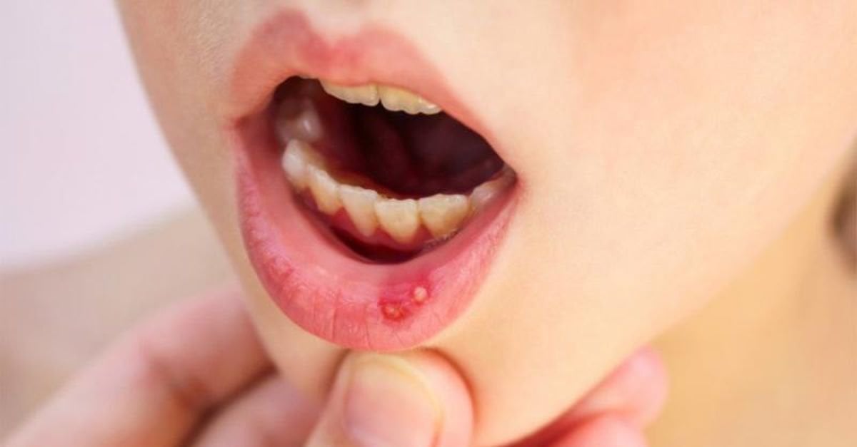 Weak immunity triggers cold sores in children #2