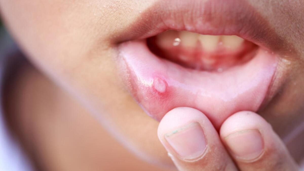 Natural Remedies For Mouth Sores