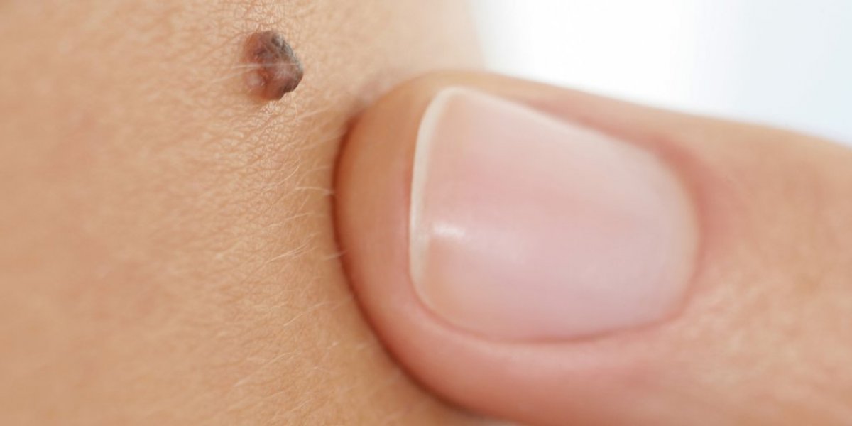 8 factors that increase the risk of skin cancer #3