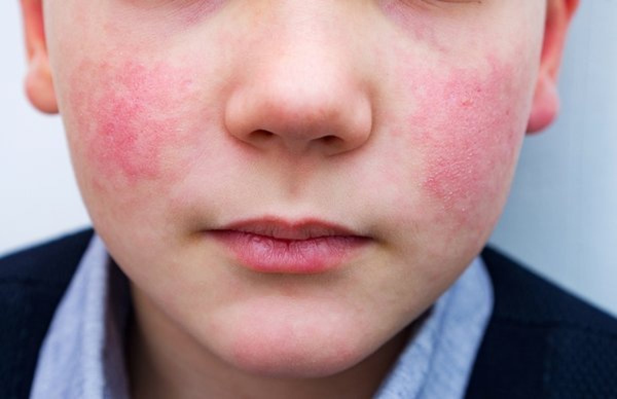 Çocuklarda kırmızı yanak beşinci hastalık belirtisi olabilir #1