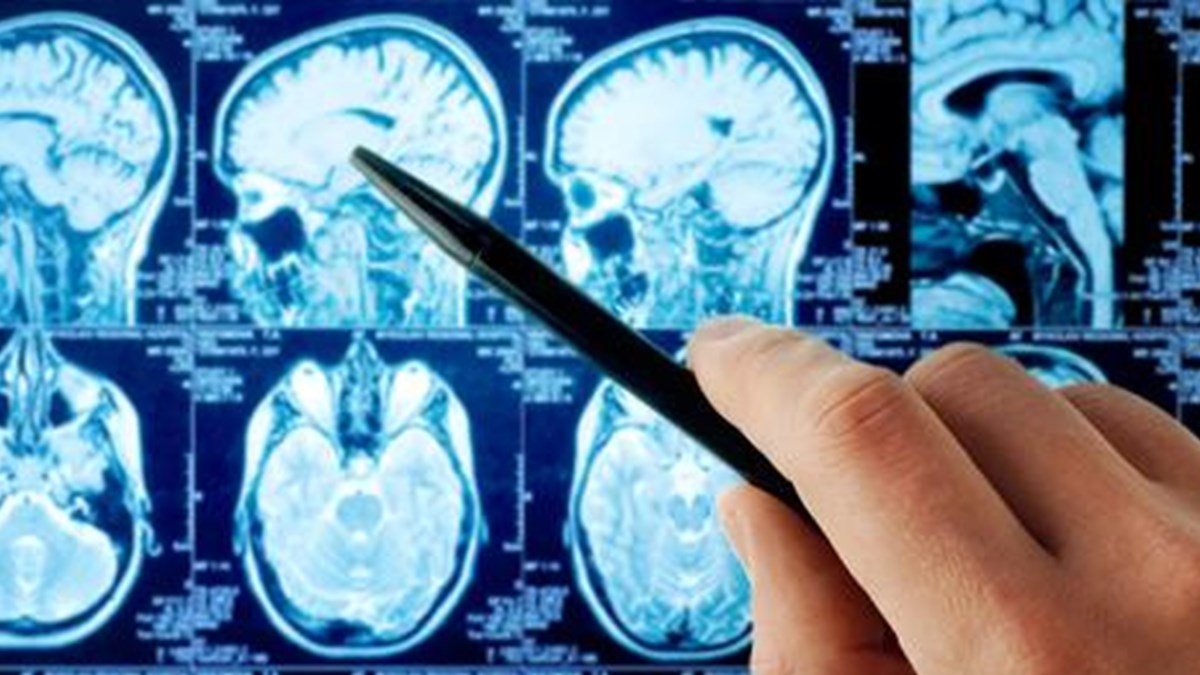 Beyin tümörü belirtileri ve tedavisi #2