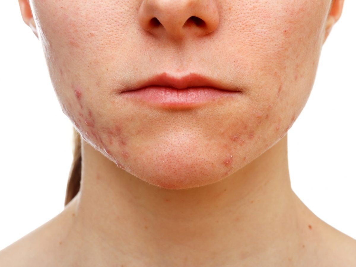 Çift maske kullanımı  maskne yi tetikliyor #1