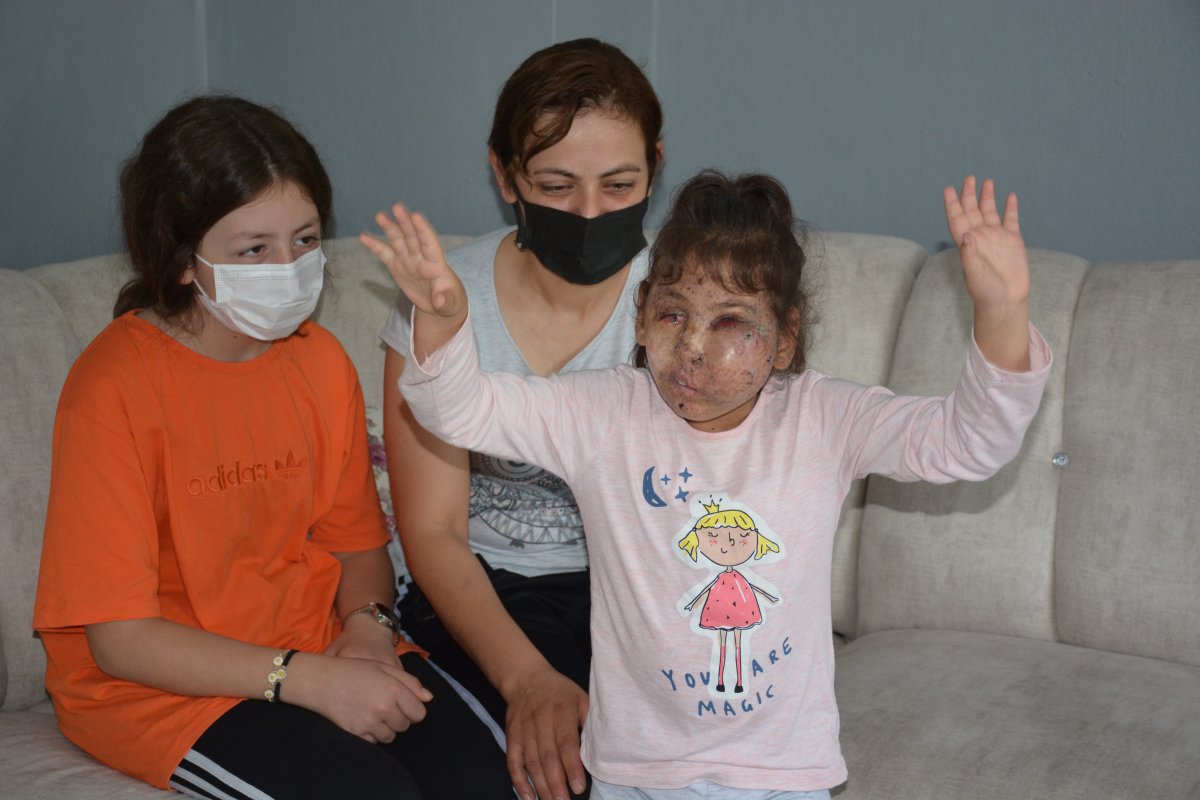 Karabük te Mikrosefali hastası Sahra, yardım bekliyor #1