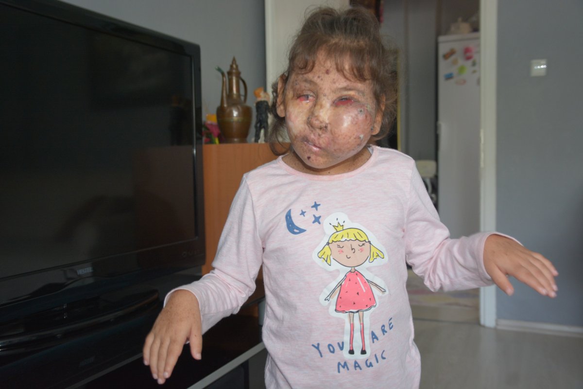 Karabük te Mikrosefali hastası Sahra, yardım bekliyor #3