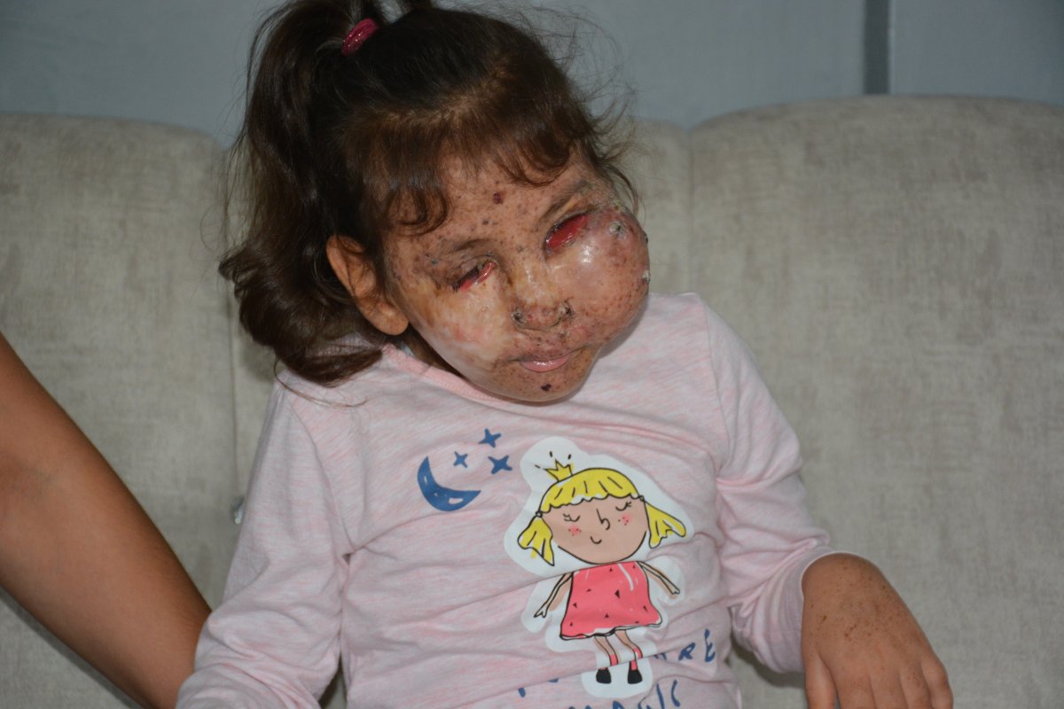 Karabük te Mikrosefali hastası Sahra, yardım bekliyor #4