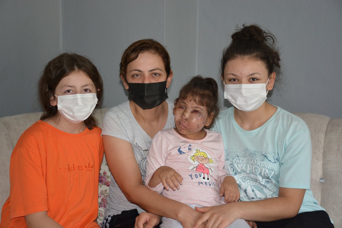 Karabük te Mikrosefali hastası Sahra, yardım bekliyor #5