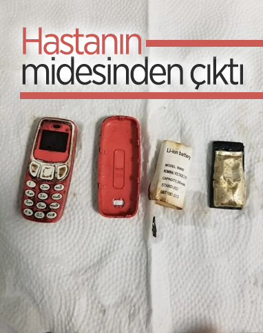 Kosova'da midesinden Nokia 3310 çıktı 