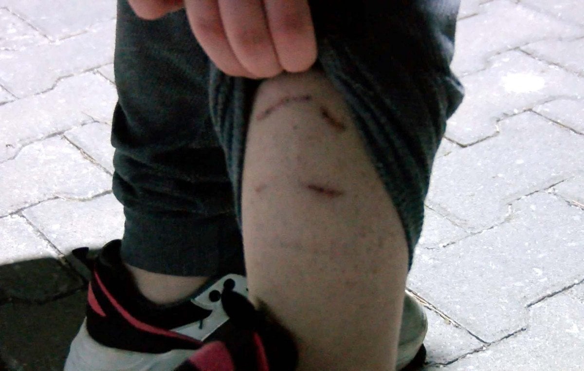 Ankara da 14 yaşındaki Defne ye sokak köpekleri saldırdı #2