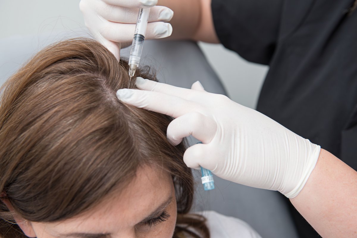 Stem cell therapy should be done before hair loss becomes permanent #2