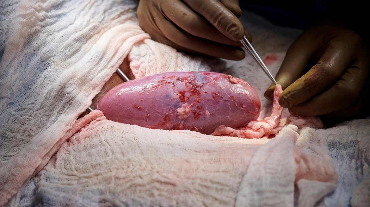 Dünyada bir ilk: Genetiğiyle oynanmış bir domuzun böbreği insana nakledildi #2