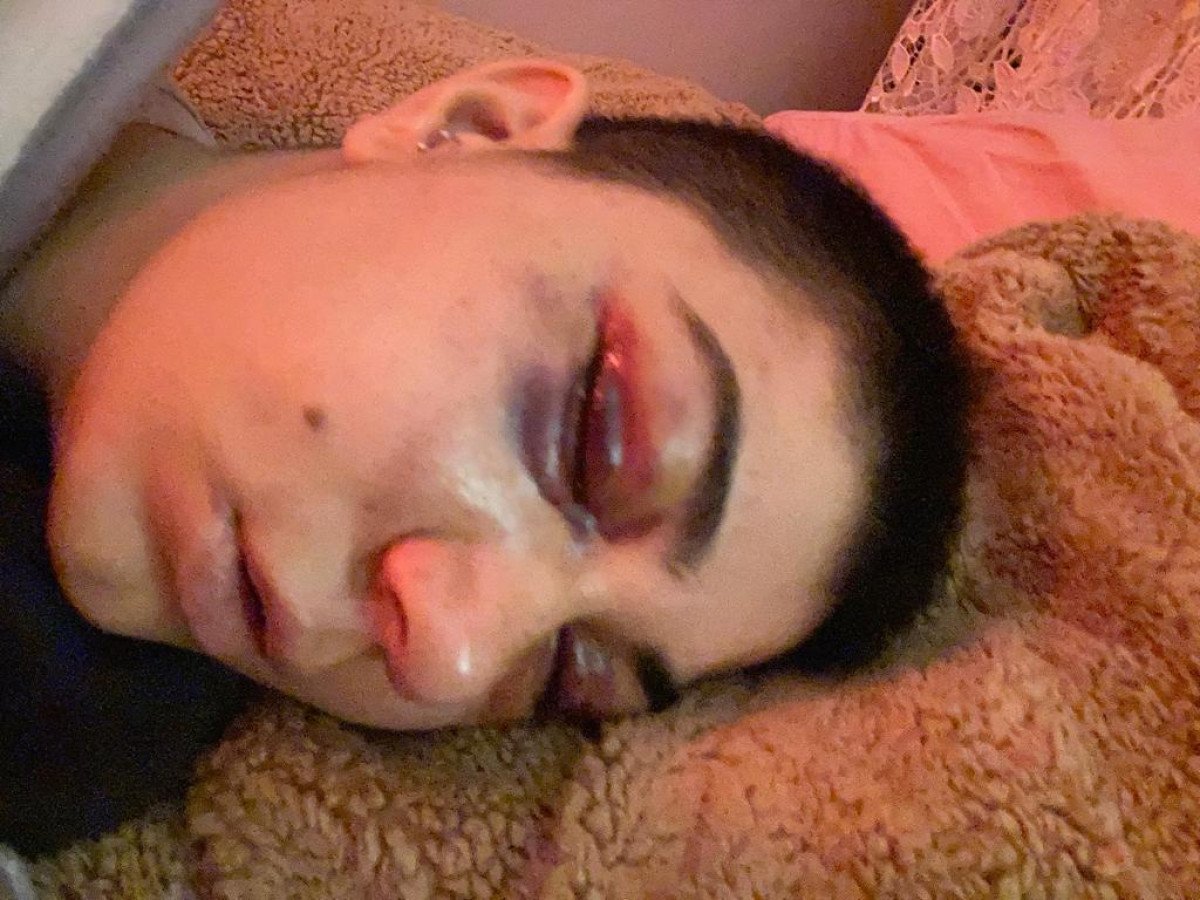 Beyoğlu nda saldırı sonrası yüzü kısmi felç oldu #1