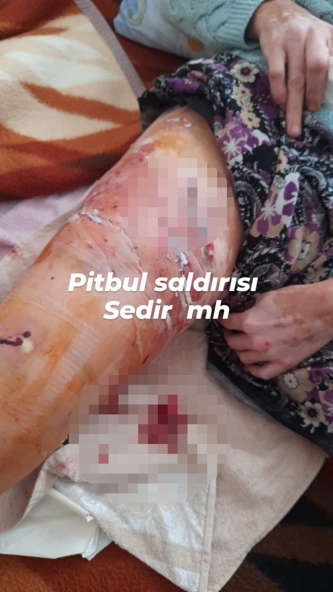 Antalya’da 45 yaşındaki kadın 2 pitbullun saldırısına uğradı #1