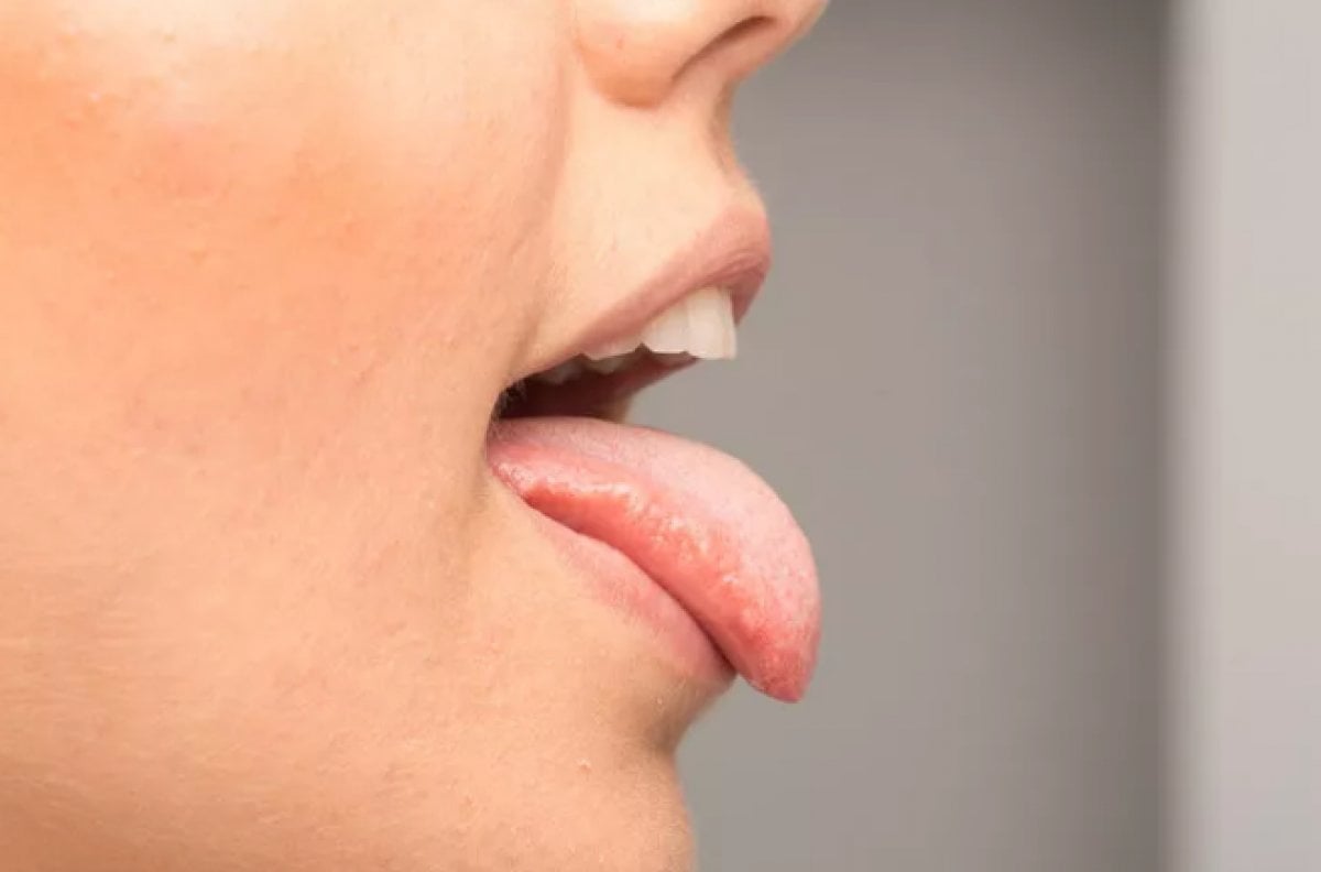Слюна после еды. Новообразования слизистой полости рта и языка.