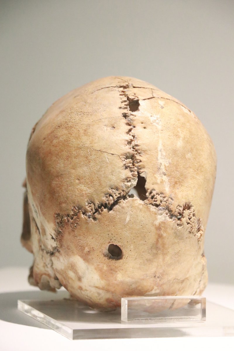 Dünyanın ilk beyin ameliyatı Aksaray da, 10 bin 500 yıl önce yapıldı #4