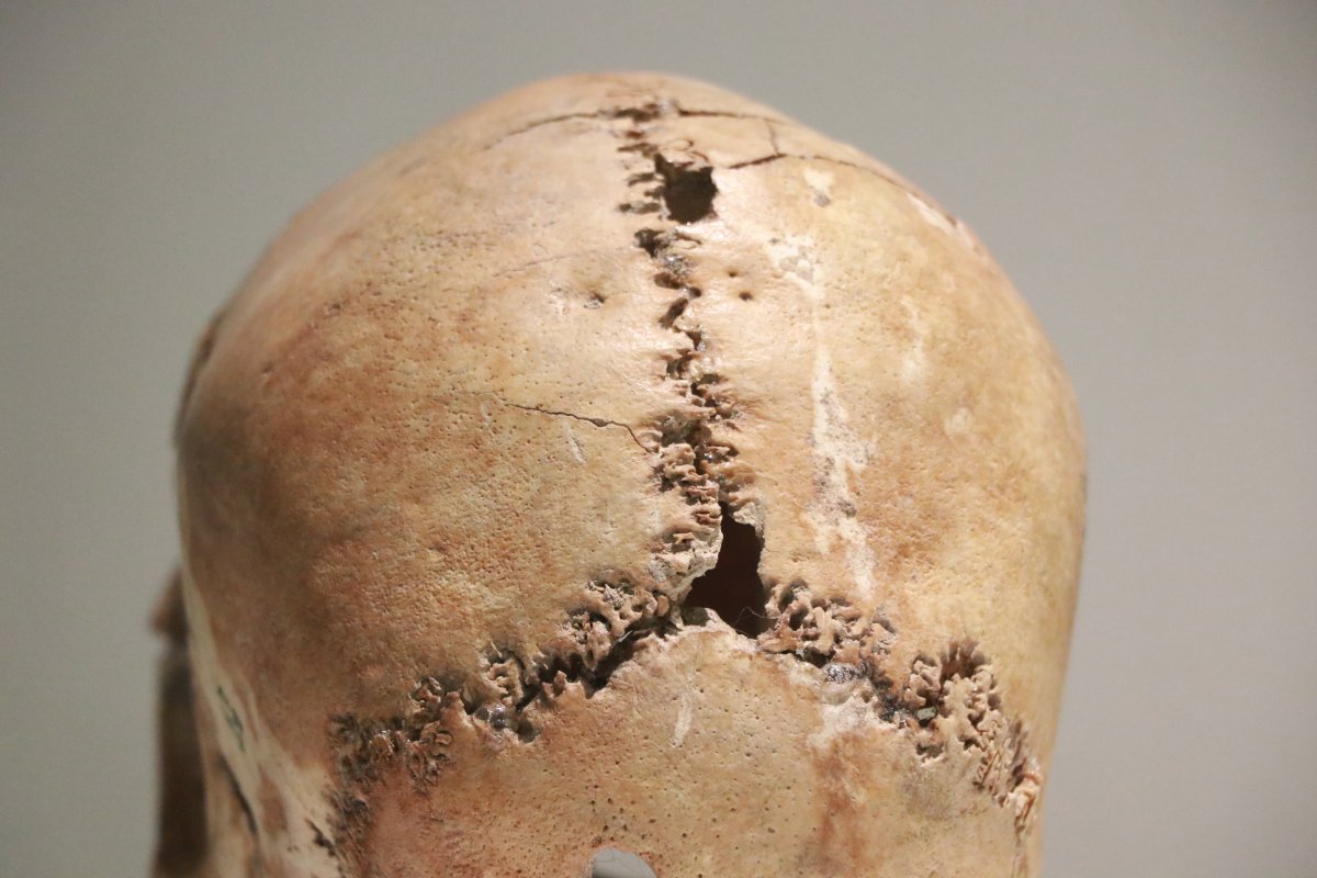 Dünyanın ilk beyin ameliyatı Aksaray da, 10 bin 500 yıl önce yapıldı #6
