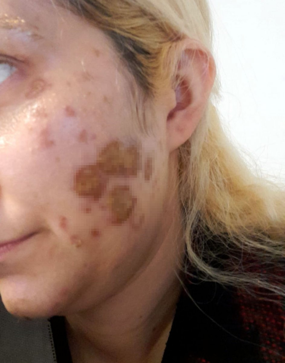 Ankara’da, kadının yüzüne kimyasal madde atan şahsın ev hapsi kaldırıldı #3