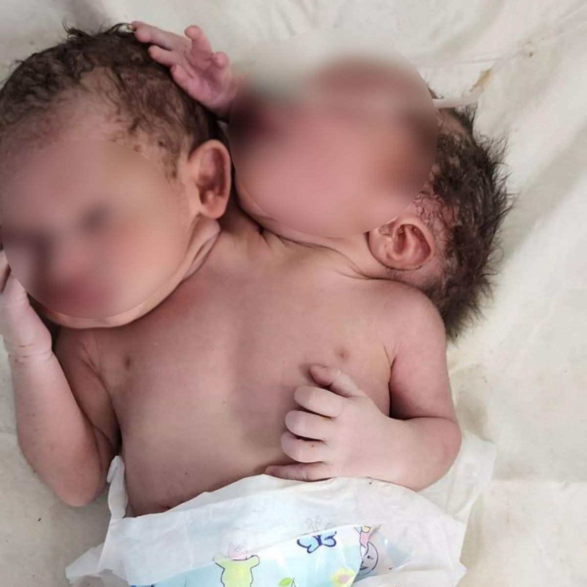 Hindistan da çift başlı bebek dünyaya geldi #1