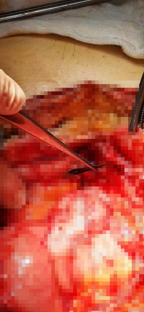 Ankara’da bir kadının midesinden 2 adet neşter çıkarıldı #3