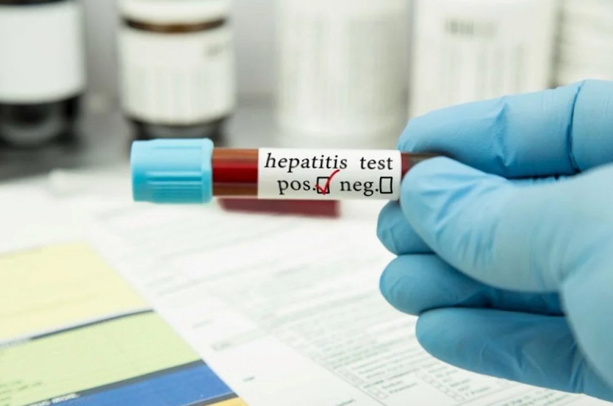 Mysterious hepatitis virus detected in Canada #3