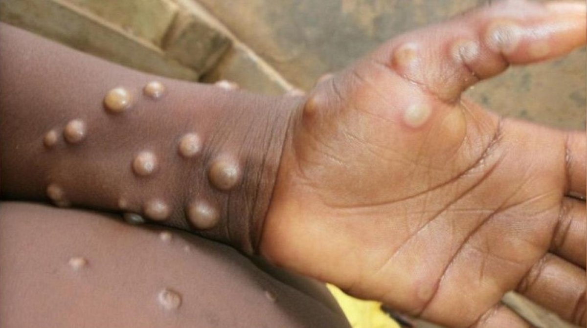 Monkeypox virus spreading: seen in 5 countries #1