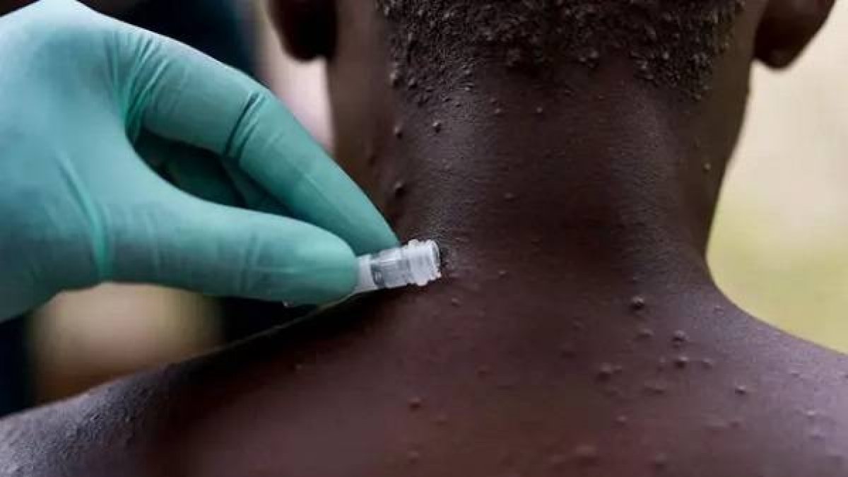African press members reacted to monkeypox virus #1