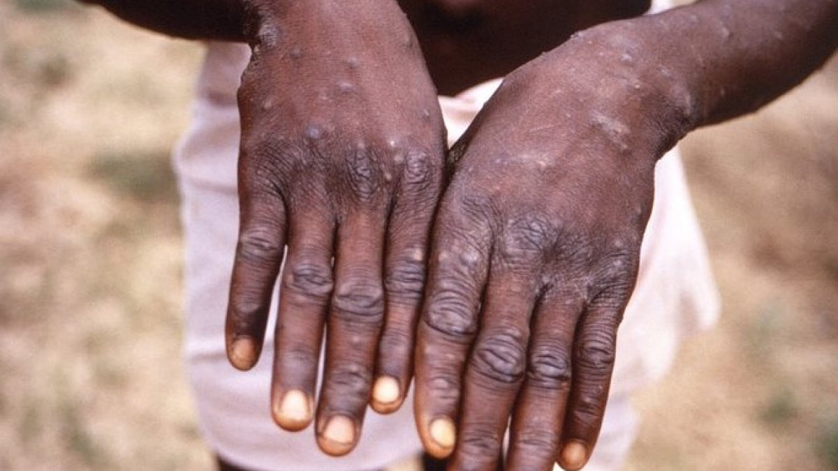 First case of monkeypox detected in Austria
