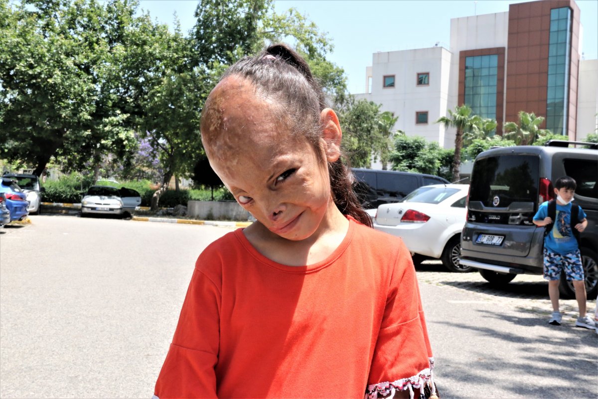 İzmir de yüzü yanan 6 yaşındaki Dilara ya, Sağlık Bakanlığı el uzattı #3