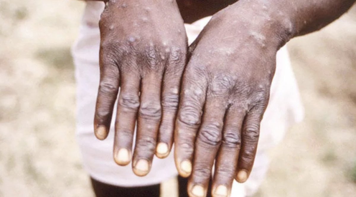 WHO: We do not expect the monkeypox virus to turn into an epidemic #1