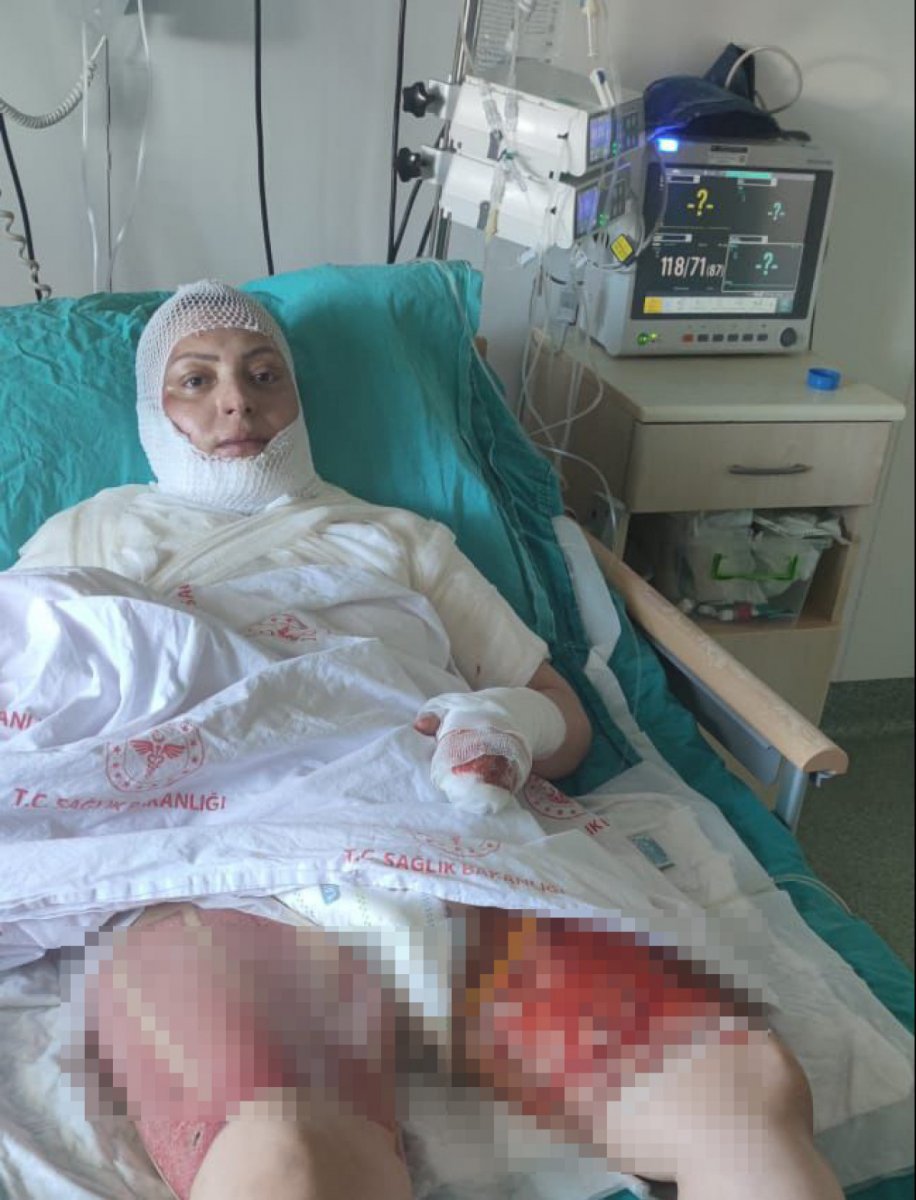 Ordu’da eski eşi tarafından yakılan kadın: Mangal yanıyormuş gibi izledi #3