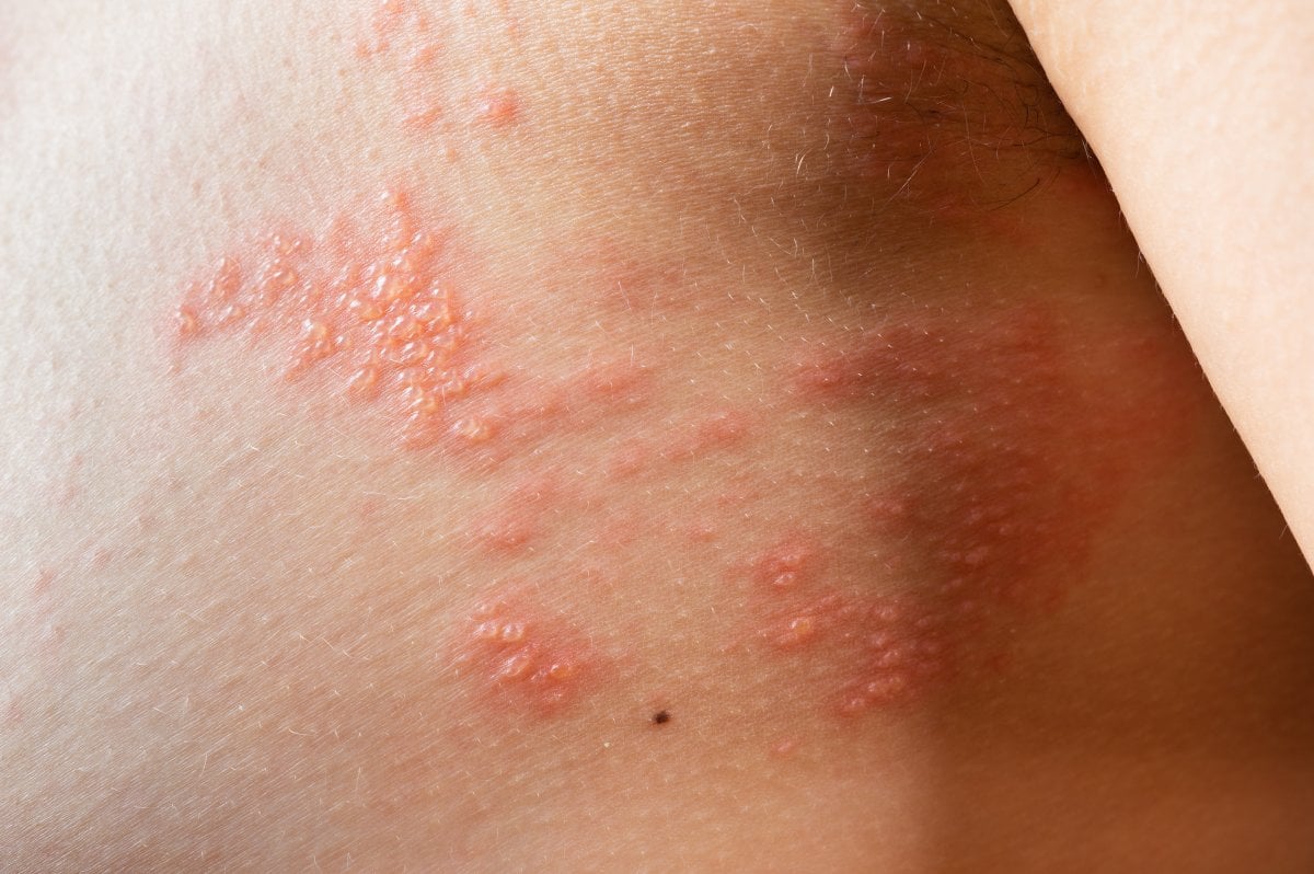 6 signes d'allergie au soleil #2