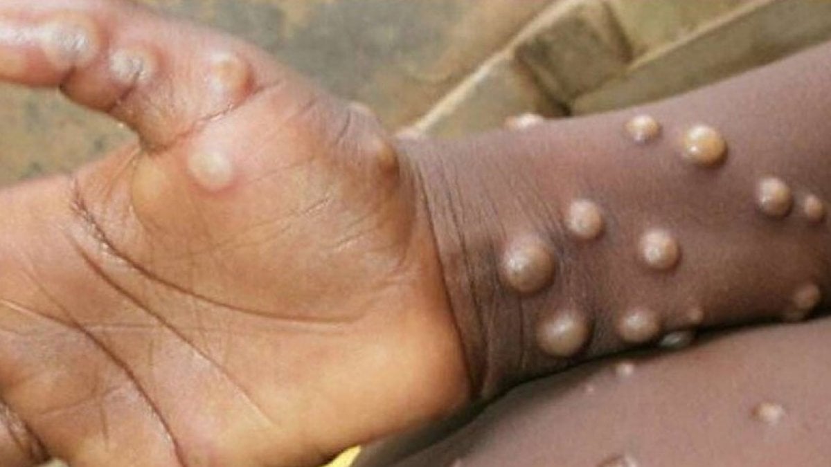 First case of monkeypox detected in Greece