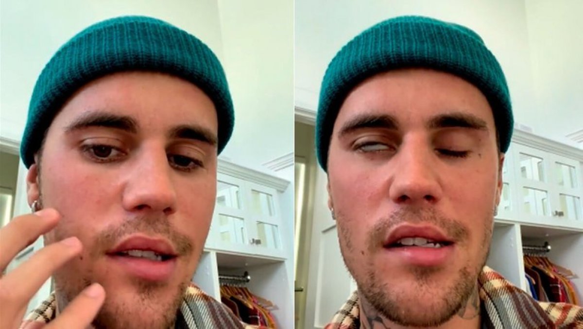 Justin Bieber in hastalığı: Ramsay Hunt sendromu nedir #1