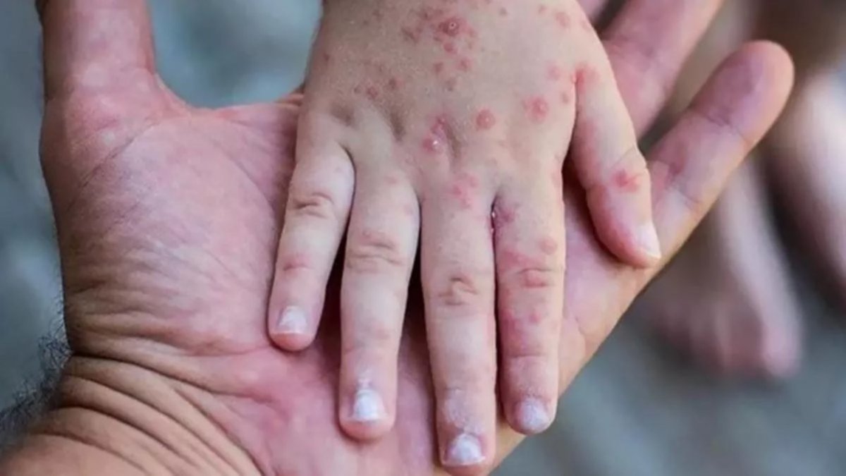 Monkeypox virus seen in 92 countries: The number of cases worldwide has exceeded 35 thousand #2