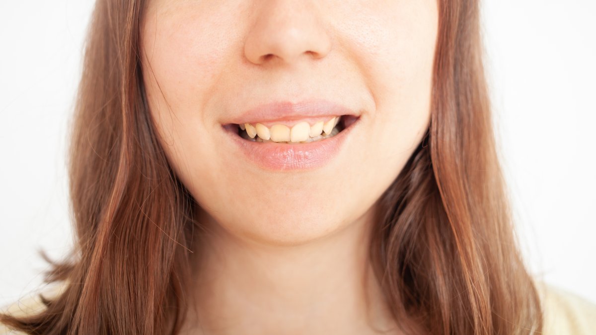 Diş beyazlatmak için 5 doğal yöntem #1