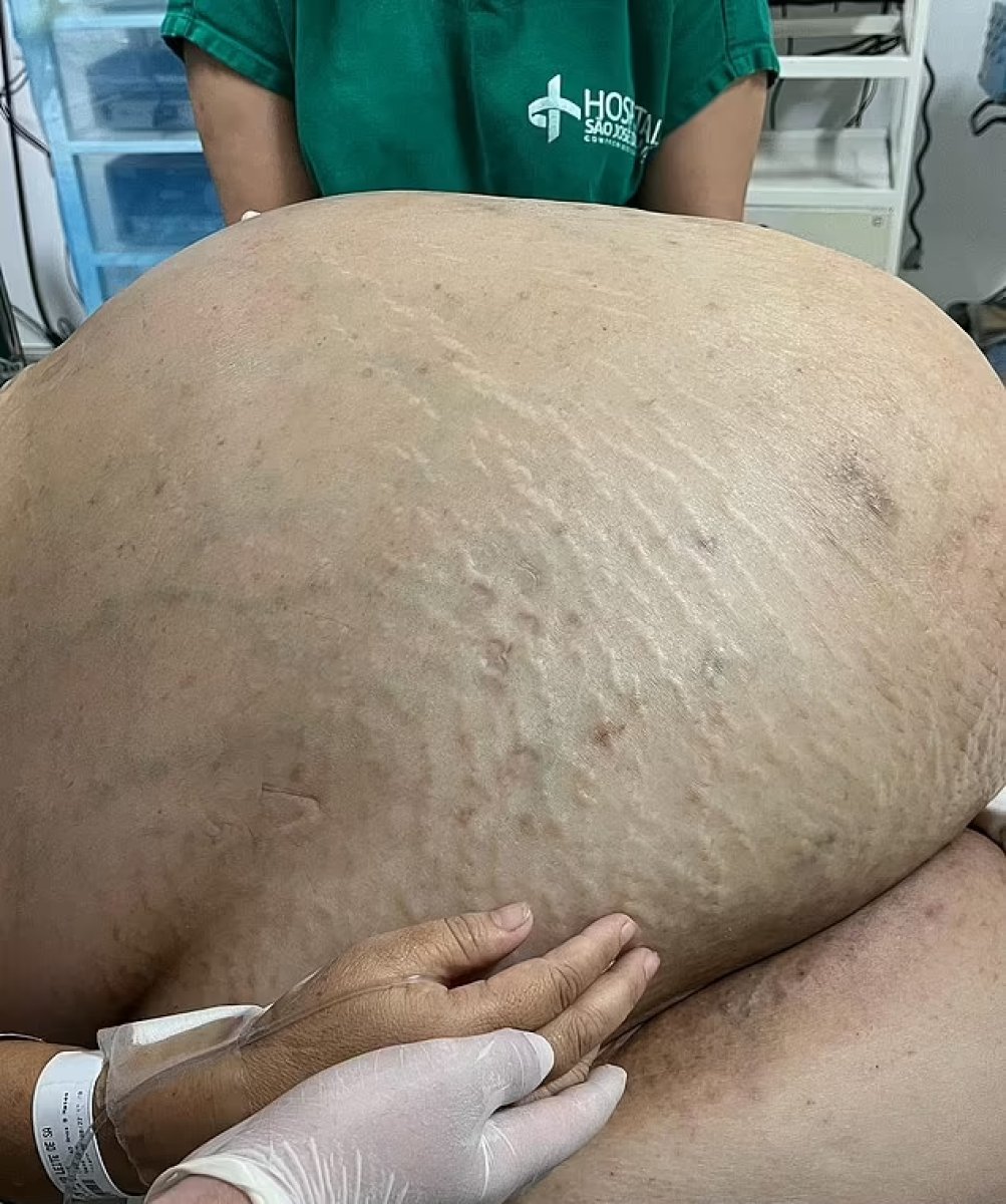 Brezilya da doktorlar, 45 kiloluk tümörü 2 saatte çıkardı #1