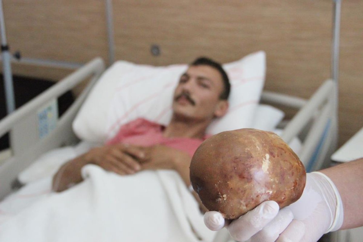 Karaman da hastaneye başvuran hastanın mesanesinden 1 kilo taş çıktı #1
