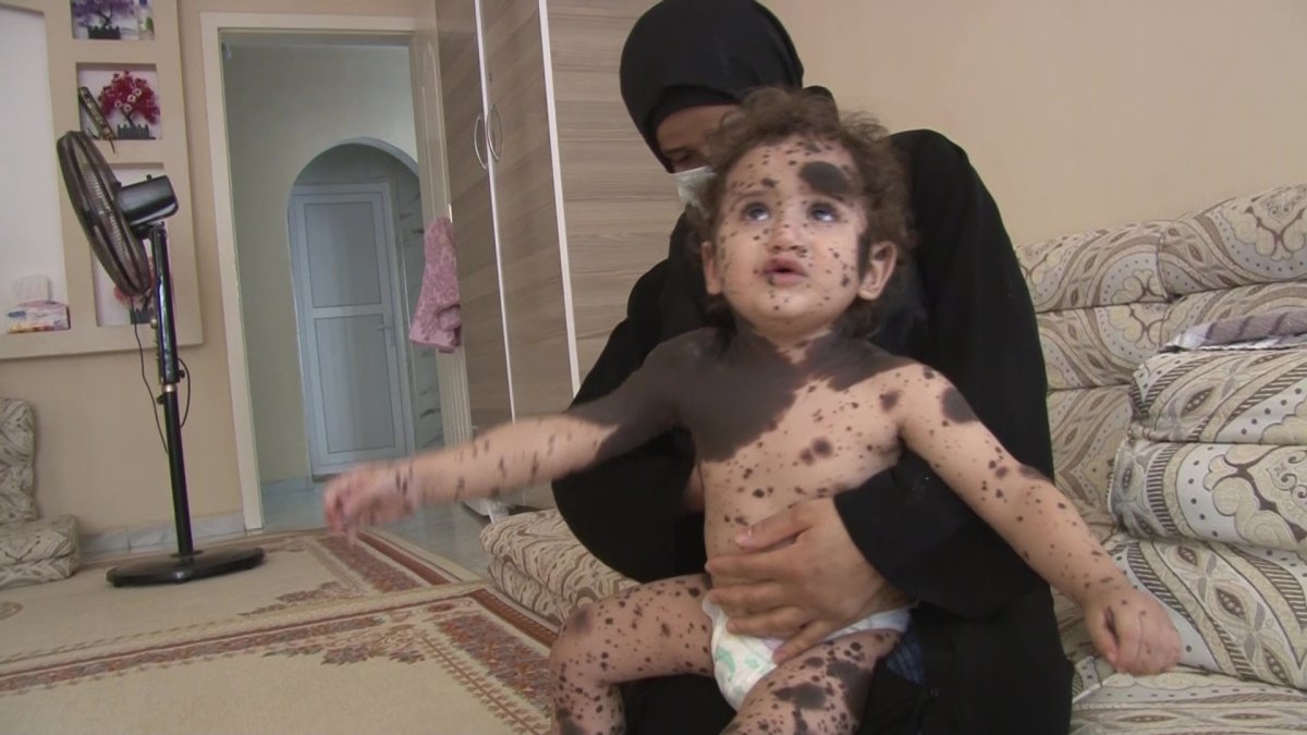 Hatay da Suriyeli bebeğin hastalığına teşhis aranıyor #2