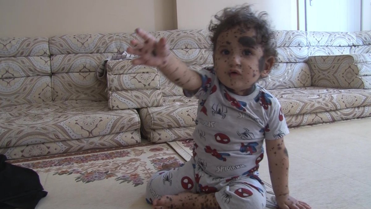 Hatay da Suriyeli bebeğin hastalığına teşhis aranıyor #1