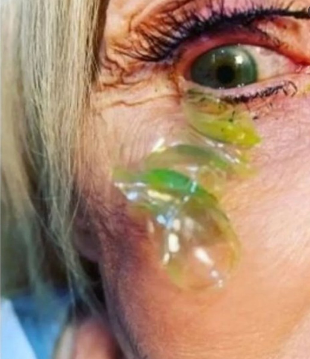 ABD’de, bir kadının gözünden 23 kontakt lens çıktı #3