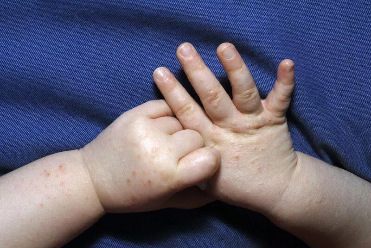 Çocuklarda el ayak ağız hastalığı nedir? Belirtileri ve tedavi yöntemleri nelerdir? #3