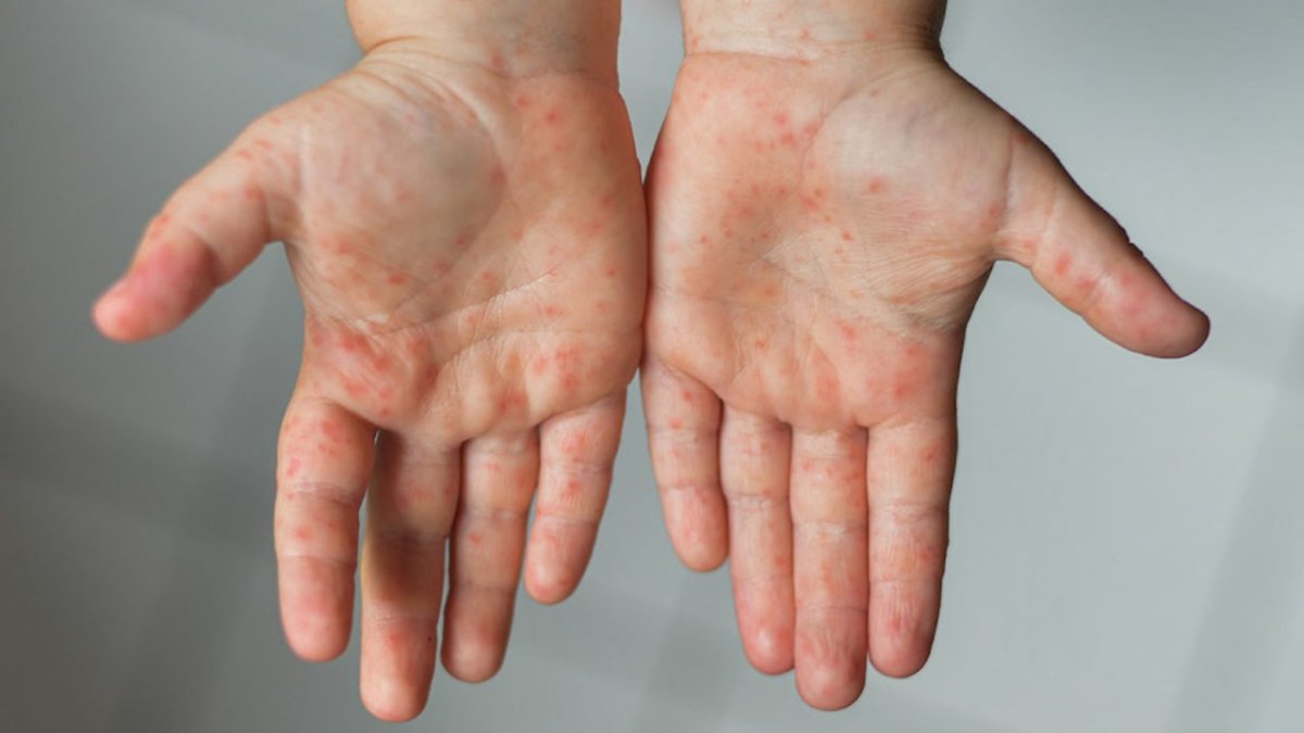 Çocuklarda el ayak ağız hastalığı nedir? Belirtileri ve tedavi yöntemleri nelerdir? #1