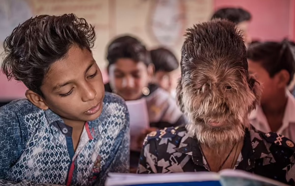 Hindistan da 17 yaşındaki genç hastalık nedeniyle kurt adama dönüştü #1