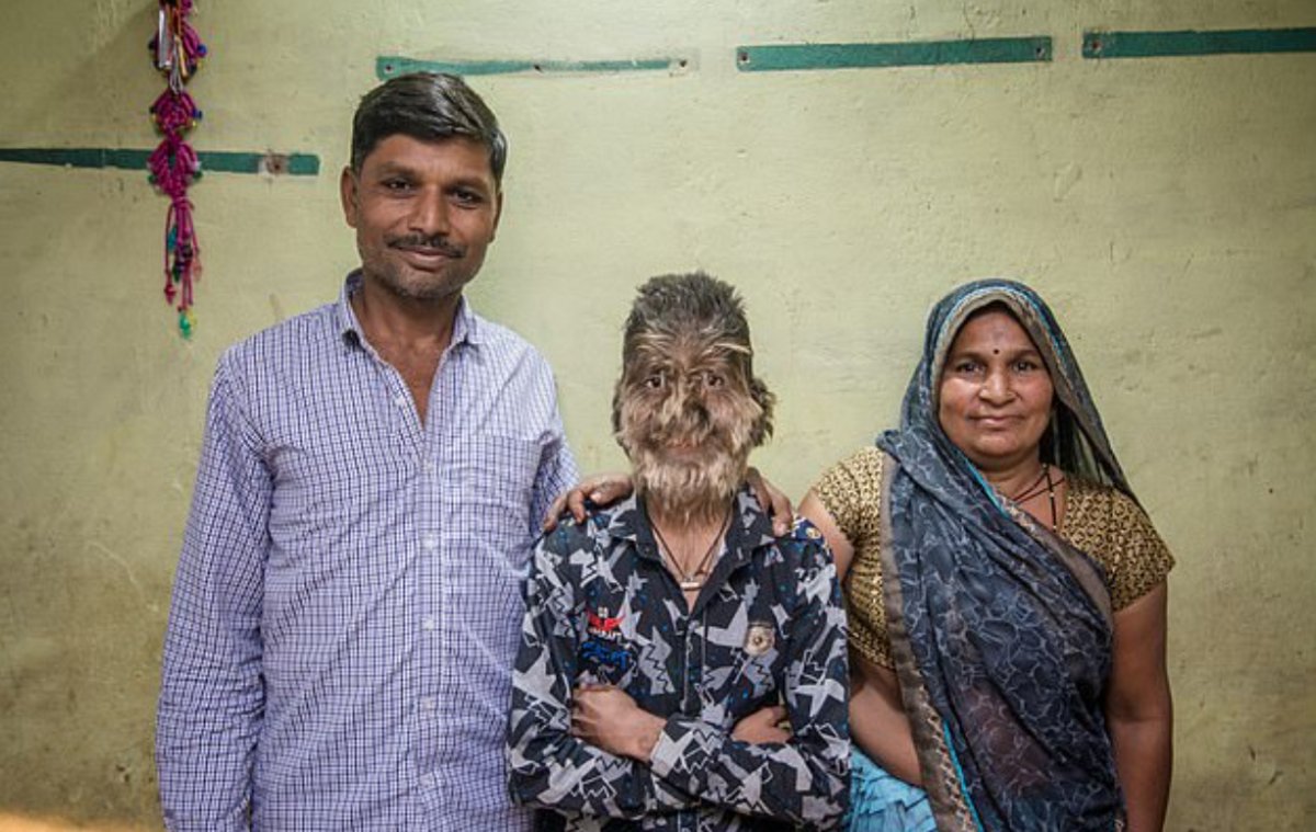 Hindistan da 17 yaşındaki genç hastalık nedeniyle kurt adama dönüştü #3