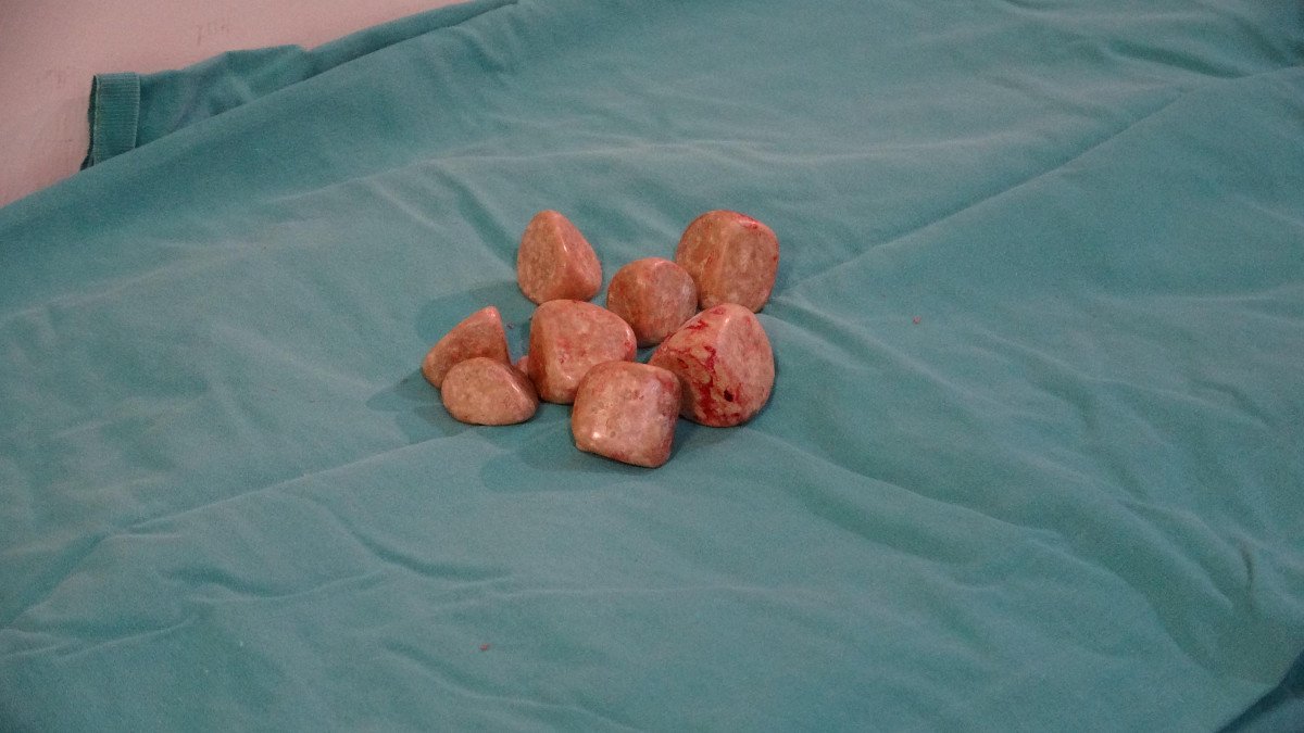 Çanakkale’de, hastanın mesanesinden 20 taş çıkarıldı #2