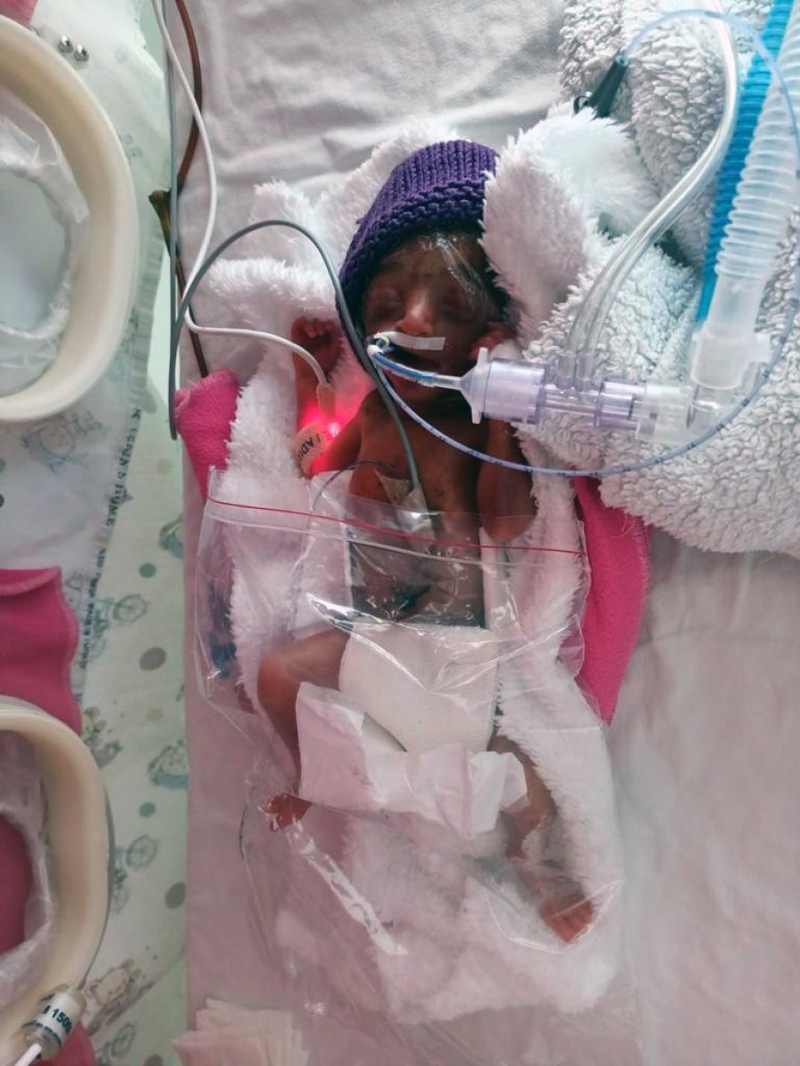 Manisa’da ‘yaşamaz’ denilen 710 gramlık Arden bebek, hayata tutundu #1