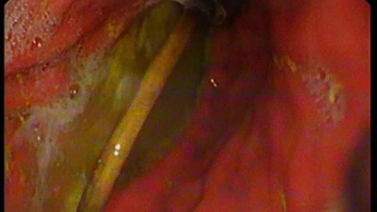 Elazığ’da, çocuğun midesinden şarj kablosu ile toka çıkarıldı  #5