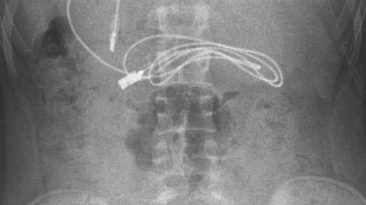 Elazığ’da, çocuğun midesinden şarj kablosu ile toka çıkarıldı  #3