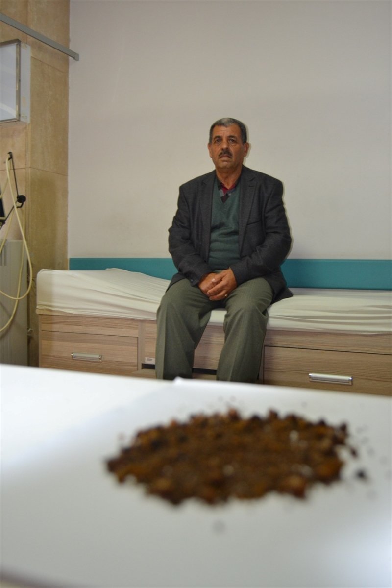 Manisa’da, hastanın safra kesesinde 4 bin 536 taş çıktı #2